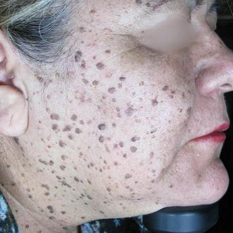 Before After-SmartXide DOT-A-2-2