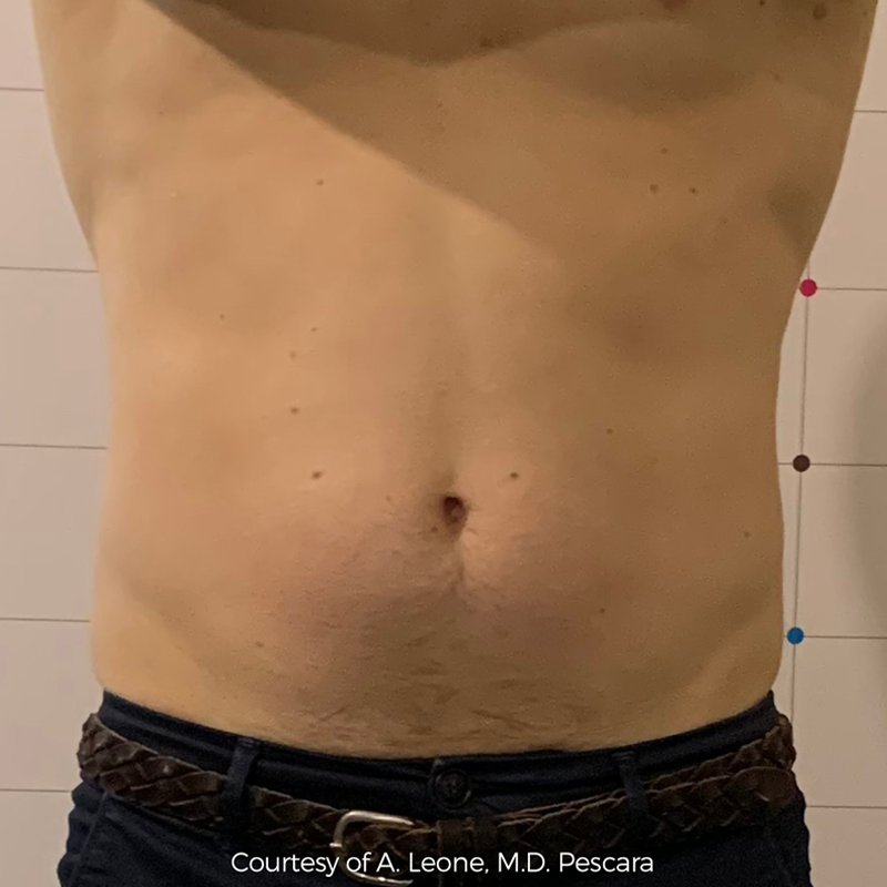 Before After-schwazy-A-1